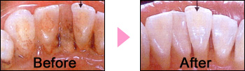 PMTC��before��after