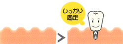 インプラントは埋め込み可能