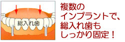 複数のインプラントで、総入れ歯もしっかり固定