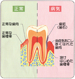 歯周病