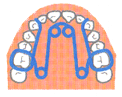 矯正装置:クワッドヘリックス