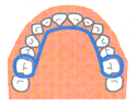 矯正装置:リンガルアーチ