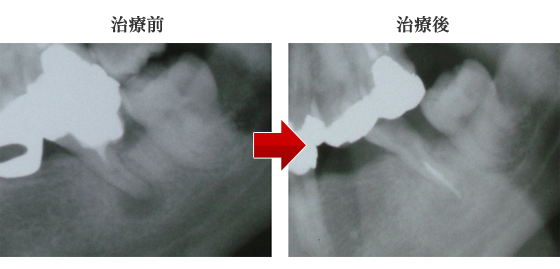 根管治療