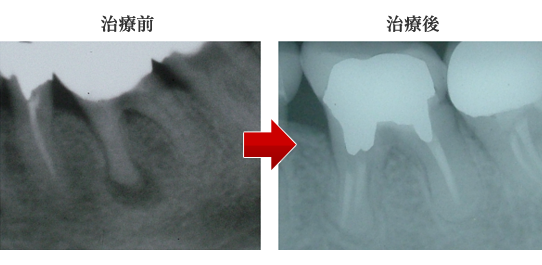 根管治療