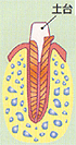 歯髄炎の場合の歯の根の治療：5